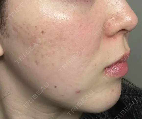 ピーリング（ニキビ・毛穴） / ピーリング（ハリ・ツヤ） / ルメッカ ハナビューティークリニック DAY 2 メイン用