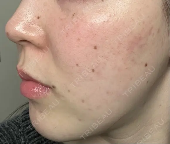 ピーリング（ニキビ・毛穴） / ピーリング（ハリ・ツヤ） / ルメッカ ハナビューティークリニック DAY 2 メイン用