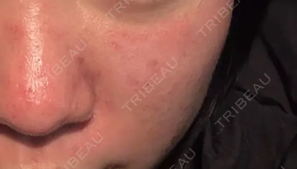 ダーマペン 大美会クリニック 京都烏丸院 DAY 0 メイン用