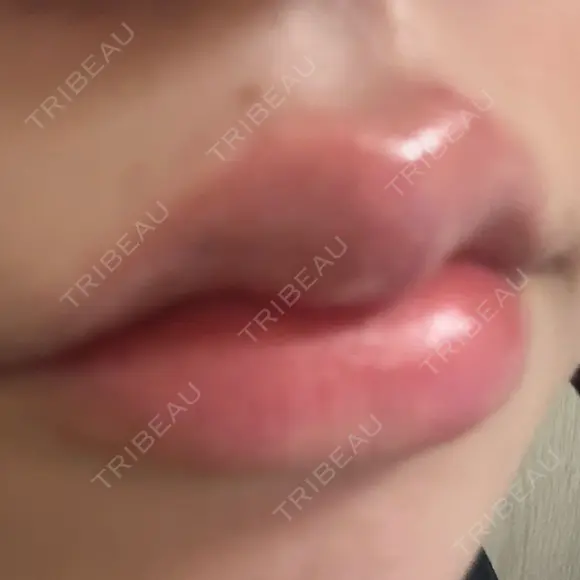 ヒアルロン酸注入（唇） / ボトックス（口角） ルラ美容クリニック 大阪本院 AFTER メイン用