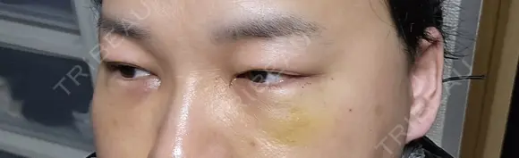 クマ治療 / 下まぶたたるみ取り 湘南美容クリニック 千葉センシティ院 DAY 6 メイン用