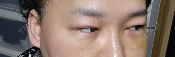 クマ治療 / 下まぶたたるみ取り 湘南美容クリニック 千葉センシティ院 DAY 6 メイン用