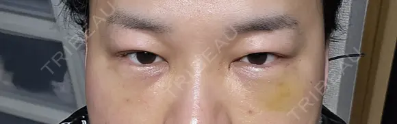 クマ治療 / 下まぶたたるみ取り 湘南美容クリニック 千葉センシティ院 DAY 6 メイン用