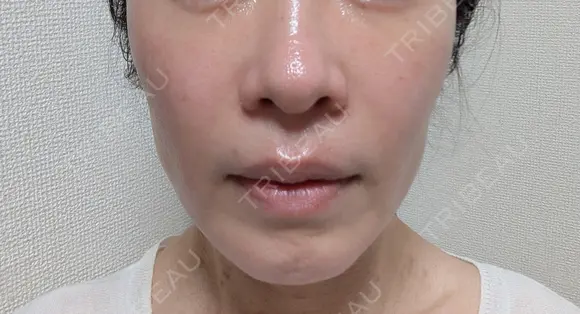 糸リフト / バッカルファット除去 / 脂肪吸引（顔） / ジョールファット除去 / ボトックス（エラ・小顔） アリエル美容クリニック 大宮院 DAY 110 メイン用