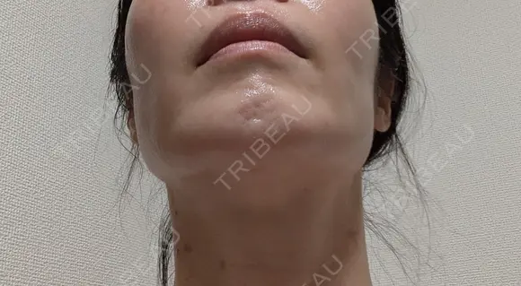 糸リフト / バッカルファット除去 / 脂肪吸引（顔） / ジョールファット除去 / ボトックス（エラ・小顔） アリエル美容クリニック 大宮院 DAY 110 メイン用
