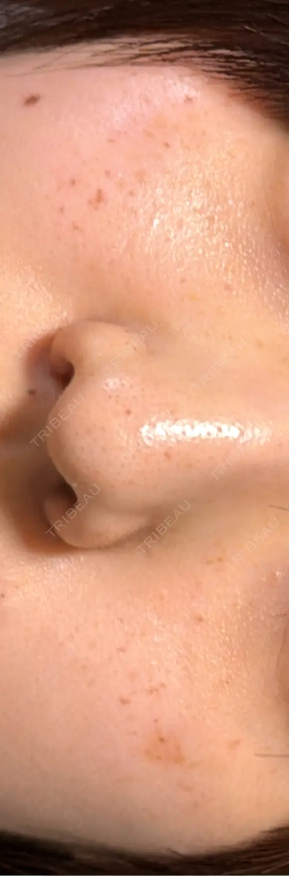 ルメッカ ハナビューティークリニック AFTER メイン用