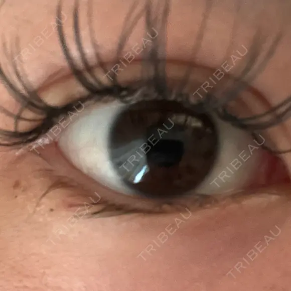 ヒアルロン酸溶解 ルラ美容クリニック 横浜院 AFTER メイン用