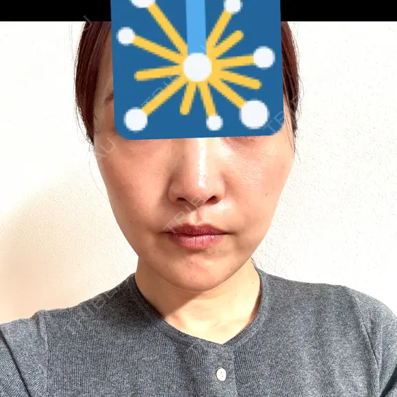 糸リフト / クマ治療 / 下まぶたたるみ取り / 脂肪注入（目の下） / ボトックス（あご） / その他（口元） アリエル美容クリニック 水戸院 DAY 45 メイン用
