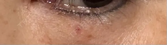 ほくろ・いぼ切除（肌） ルラ美容クリニック 横浜院 DAY 4 メイン用