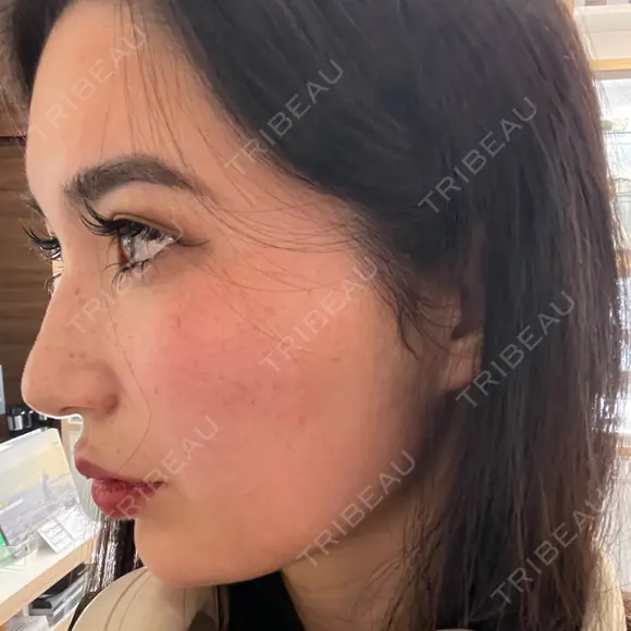 ヒアルロン酸注入（鼻） / ヒアルロン酸注入（鼻翼基部） HAAB×DREAM BEAUTY CLINIC 大阪梅田院 AFTER メイン用