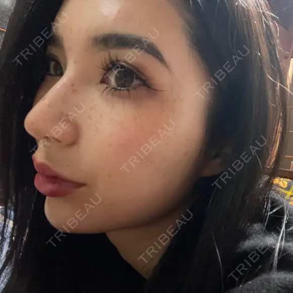 ヒアルロン酸注入（鼻） / ヒアルロン酸注入（鼻翼基部） HAAB×DREAM BEAUTY CLINIC 大阪梅田院 DAY 0 メイン用