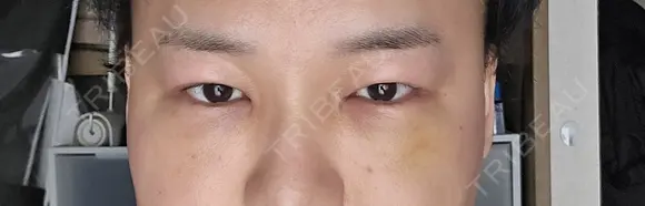 クマ治療 / 下まぶたたるみ取り 湘南美容クリニック 千葉センシティ院 AFTER メイン用