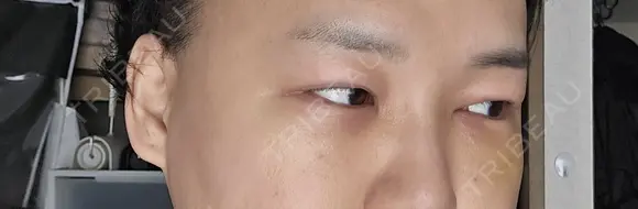 クマ治療 / 下まぶたたるみ取り 湘南美容クリニック 千葉センシティ院 DAY 7 メイン用