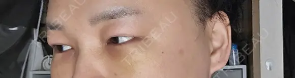 クマ治療 / 下まぶたたるみ取り 湘南美容クリニック 千葉センシティ院 DAY 7 メイン用