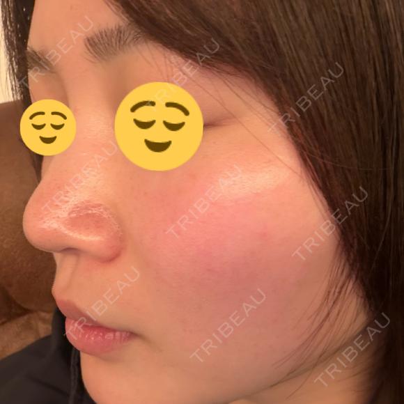 ルメッカ BITO BEAUTY CLINIC AFTER メイン用