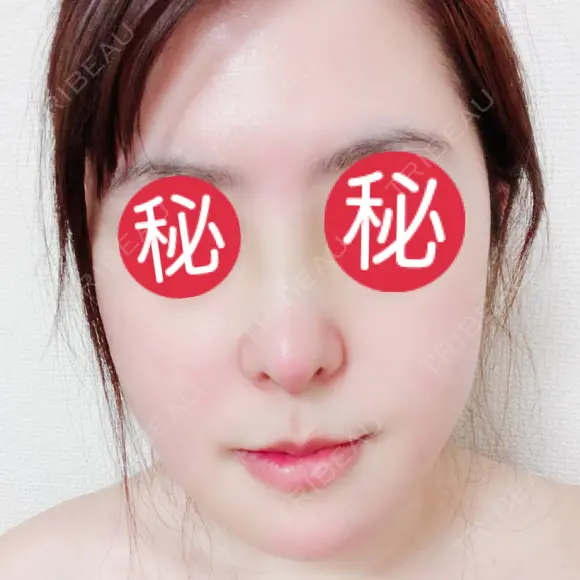 鼻中隔延長（切開） / 骨切り（あご） / 骨削り（エラ） / 軟骨移植 / 眉間プロテーゼ id（アイディ）美容外科 DAY 7 メイン用