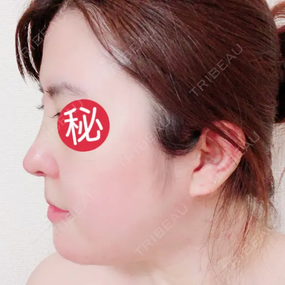 鼻中隔延長（切開） / 骨切り（あご） / 骨削り（エラ） / 軟骨移植 / 眉間プロテーゼ id（アイディ）美容外科 DAY 7 メイン用