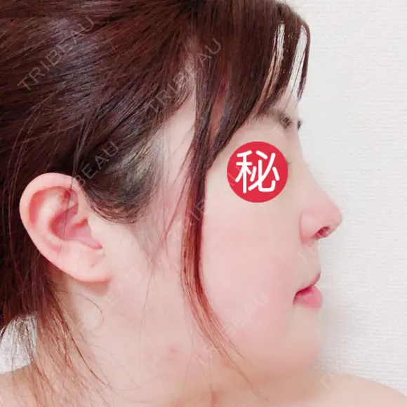 鼻中隔延長（切開） / 骨切り（あご） / 骨削り（エラ） / 軟骨移植 / 眉間プロテーゼ id（アイディ）美容外科 DAY 7 メイン用