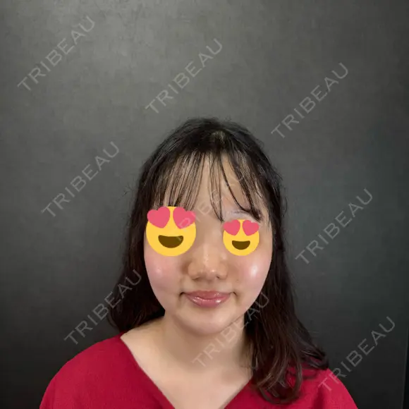 脂肪吸引（顔） ネビュラクリニック 京都院 DAY 0 メイン用