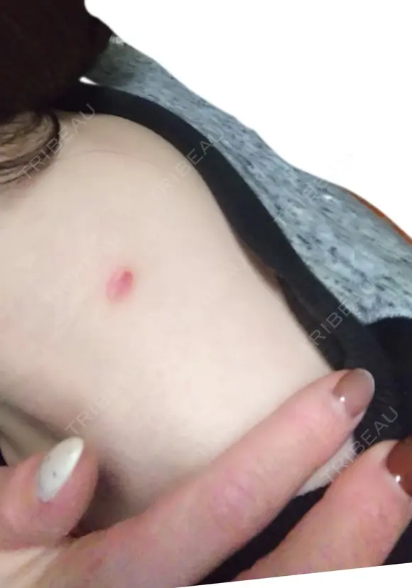 ほくろ・いぼ除去レーザー（肌） Fellez Clinic【フェルズクリニック】 DAY 16 メイン用