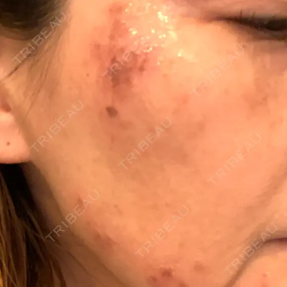 シミ取りレーザー S-Laboクリニック 渋谷院 DAY 0 メイン用