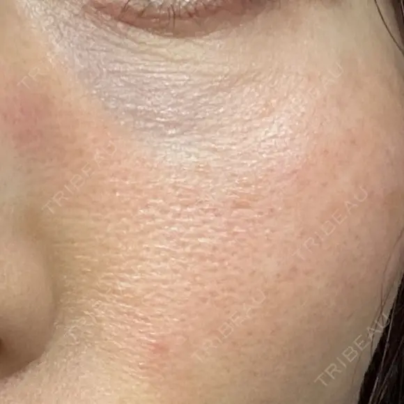 美肌レーザー LEX BEAUTY CLINIC DAY 8 メイン用