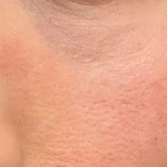 美肌レーザー LEX BEAUTY CLINIC DAY 9 メイン用