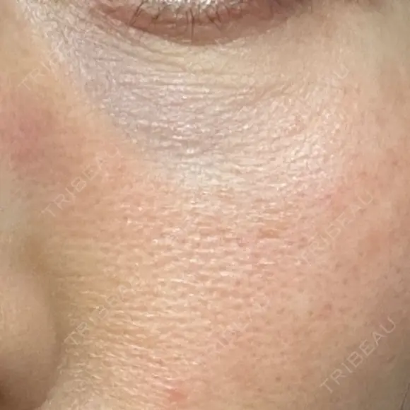 その他（目元） 品川スキンクリニック広島院 DAY 1 メイン用