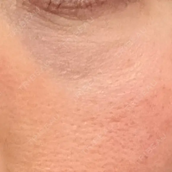 その他（目元） 品川スキンクリニック広島院 DAY 2 メイン用