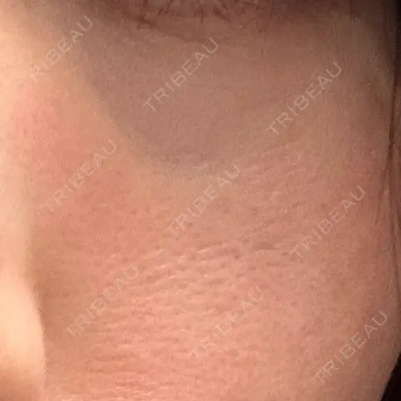 美肌レーザー LEX BEAUTY CLINIC DAY 11 メイン用