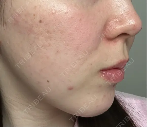 ピーリング（ニキビ・毛穴） / ピーリング（ハリ・ツヤ） / ルメッカ ハナビューティークリニック DAY 4 メイン用