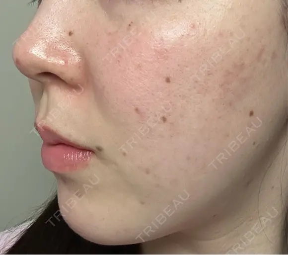 ピーリング（ニキビ・毛穴） / ピーリング（ハリ・ツヤ） / ルメッカ ハナビューティークリニック DAY 4 メイン用