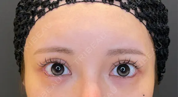 目尻切開 / タレ目形成・グラマラスライン（埋没） LOUIS CLINIC 二子玉川院【ルイクリニック】 AFTER メイン用