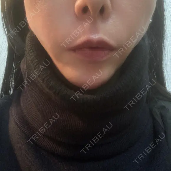 糸リフト 形成外科と美容外科のクリニック池袋 AFTER メイン用