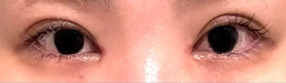 二重埋没 / 目頭切開 湘南美容クリニック 千葉センシティ院 AFTER メイン用