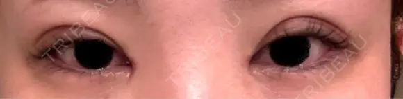 二重埋没 / 目頭切開 湘南美容クリニック 千葉センシティ院 DAY 15 メイン用