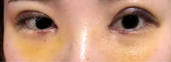 二重埋没 / 目頭切開 湘南美容クリニック 千葉センシティ院 DAY 7 メイン用