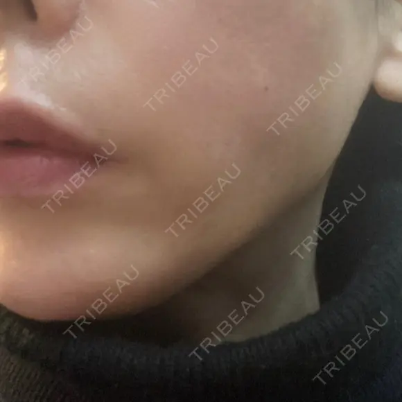 糸リフト 形成外科と美容外科のクリニック池袋 DAY 0 メイン用