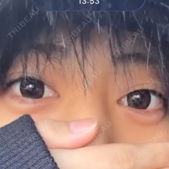 ヒアルロン酸注入（涙袋） サラ美容外科 AFTER メイン用