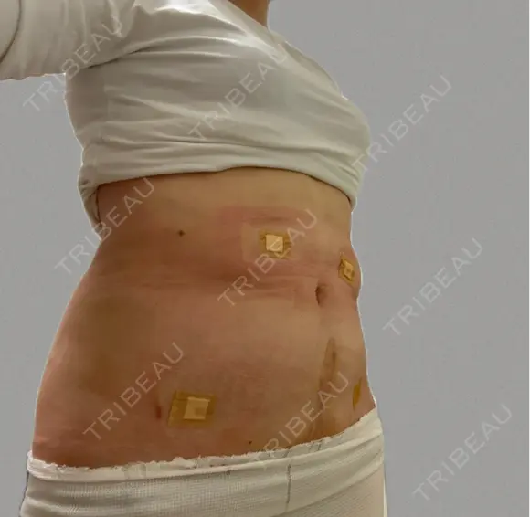 脂肪吸引（お腹） eクリニック 広島院 AFTER メイン用