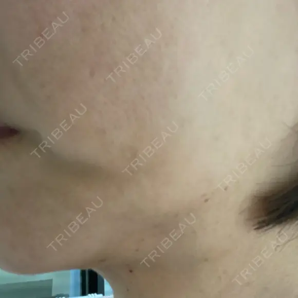 ヒアルロン酸溶解 / インモード Moon Beauty Clinic DAY 5 メイン用