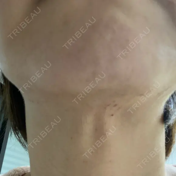 ヒアルロン酸溶解 / インモード Moon Beauty Clinic DAY 5 メイン用
