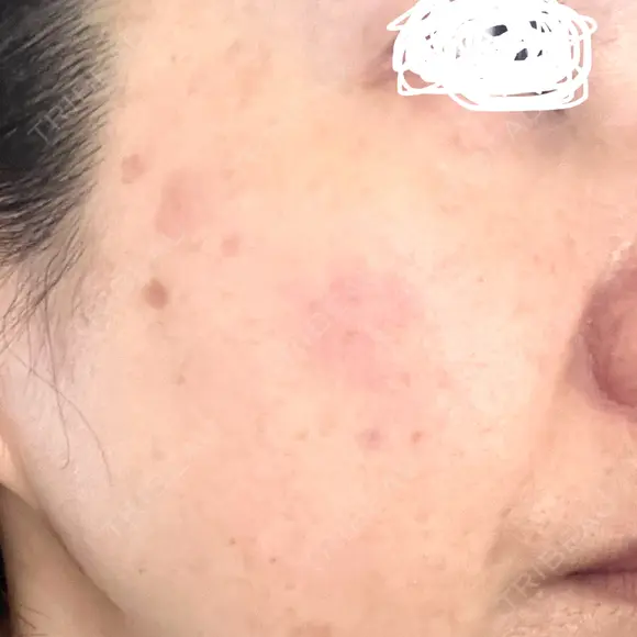 プラセンタ注射 / シミ取りレーザー S-Laboクリニック 渋谷院 DAY 19 メイン用