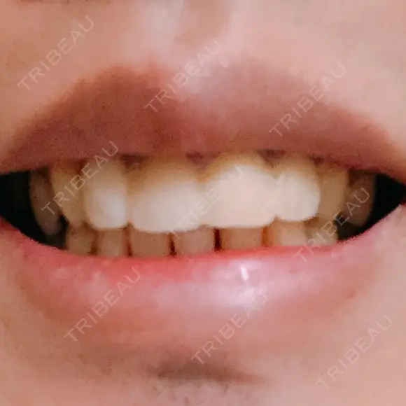 セラミック 東京美容外科 赤坂院 DAY 16 メイン用