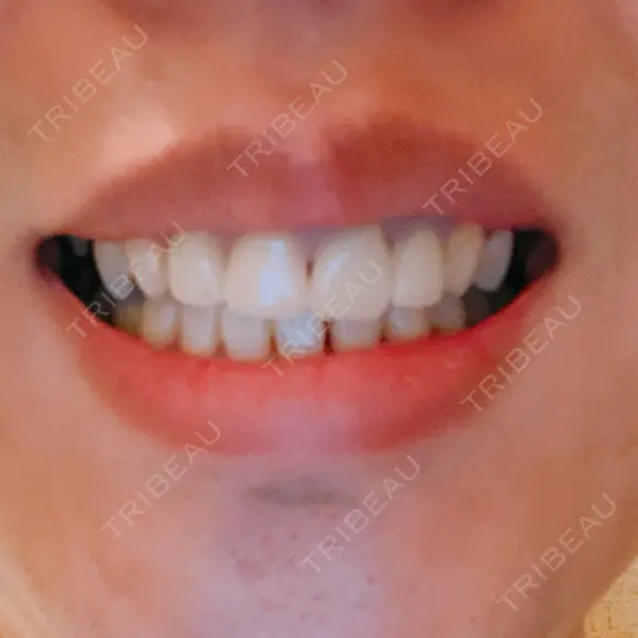 セラミック 東京美容外科 赤坂院 AFTER メイン用