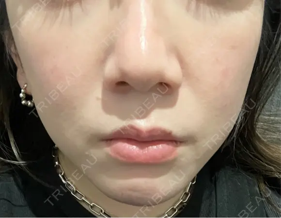 ハイフ（顔） Natural Skin Clinic 自由ヶ丘院 AFTER メイン用