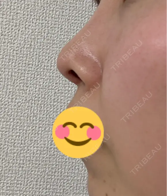 鼻尖形成（切開） / 鼻中隔延長（切開） / 軟骨移植 / 眉間プロテーゼ eクリニック 福岡院 DAY 41 メイン用