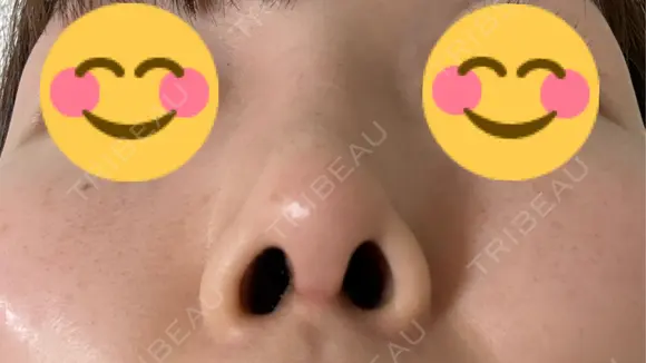 鼻尖形成（切開） / 鼻中隔延長（切開） / 軟骨移植 / 眉間プロテーゼ eクリニック 福岡院 DAY 41 メイン用