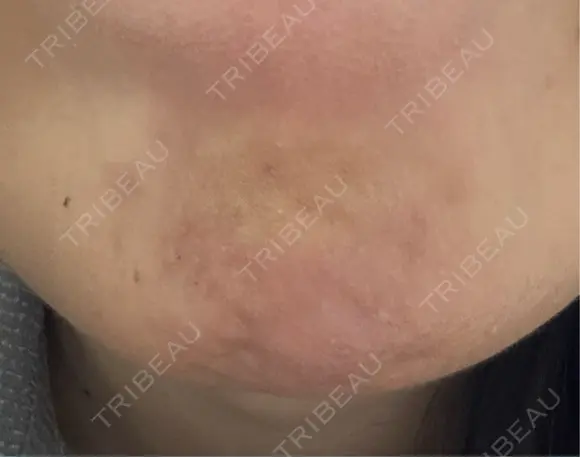 ボトックス（あご） 池袋美容クリニック DAY 0 メイン用