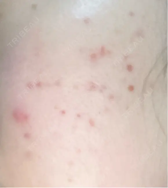 その他（肌） / ポテンツァ ルラ美容クリニック 郡山院 DAY 7 メイン用